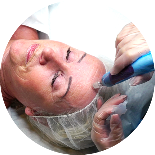 Microneedling